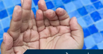 มือโดนน้ำแล้วเหี่ยว เกิดจากอะไร ควรทำอย่างไร 2